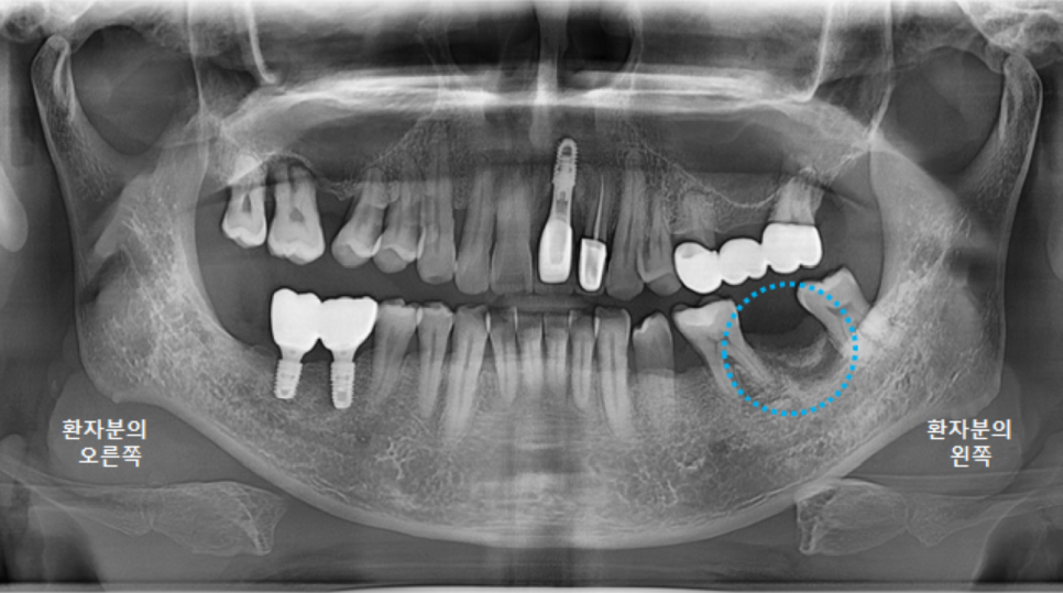 고덕동치과 서울바르디치과 전치부 및 구치부 임플란트 치료증례 #9 관련 이미지 11