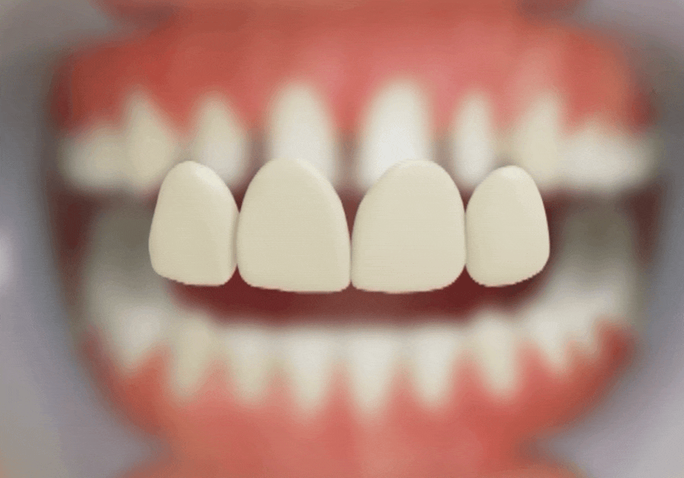 명일동 치과, 미백하면 연예인 치아처럼 새하얘진다는 말, 저는 못하겠습니다. 관련 이미지 5