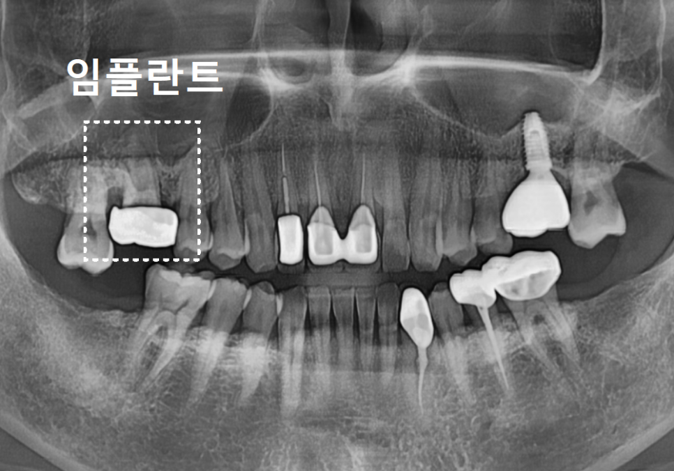 상일역 치과, 오래된 금니 빠짐, 같은 증상으로 내원했지만 전혀 다른 결과, 그 차이는? 관련 이미지 8