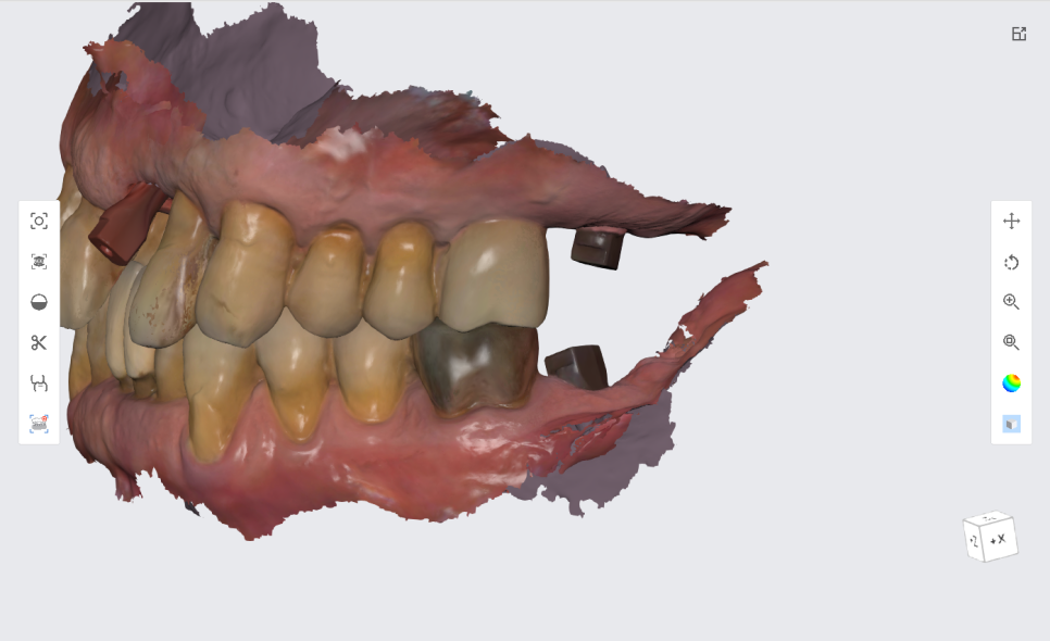 상일동치과 서울바르디치과 무절개 네비게이션 임플란트 치료증례 #3 관련 이미지 11