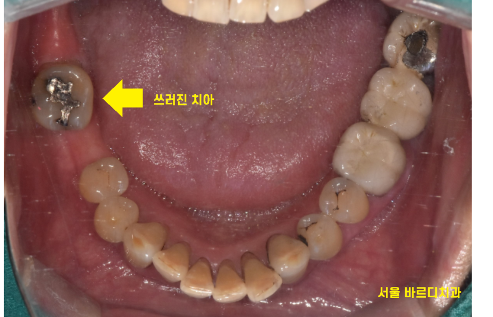 고덕역 치과 빠진 어금니 방치 그대로 두다가는 임플란트가..? 관련 이미지 4