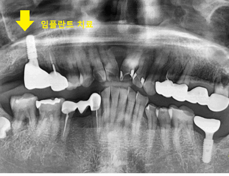명일역 근처 치과 치아 뿌리 염증이 생겨서 고생하신 사연 관련 이미지 1