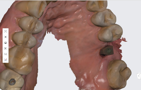 서울바르디치과 상하악 대구치 네비게이션 임플란트 치료증례 #4 관련 이미지 17