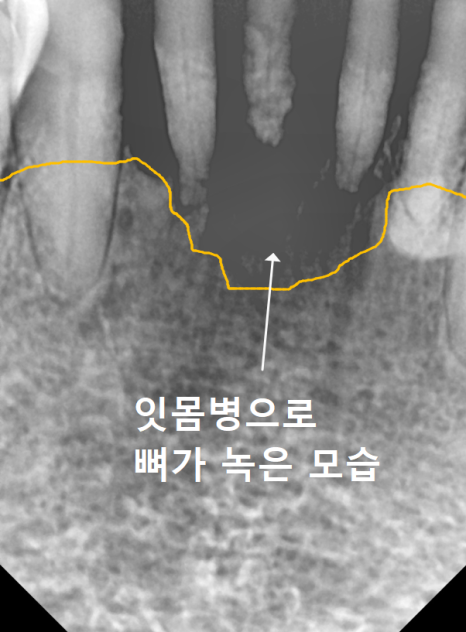 뿌리만 남은 치아, 그대로 두면 왜 위험할까요? 고덕동 전체 임플란트 재건 사례 관련 이미지 8