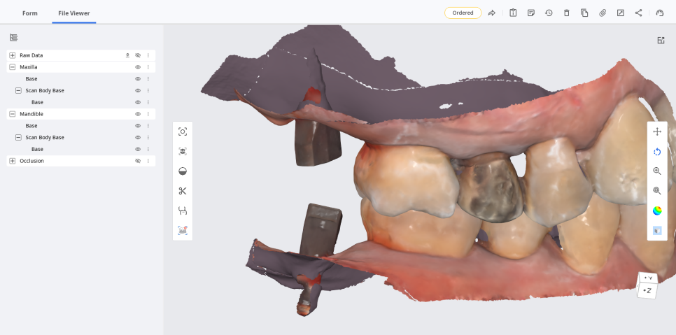 상일동치과 서울바르디치과 무절개 네비게이션 임플란트 치료증례 #7 관련 이미지 7