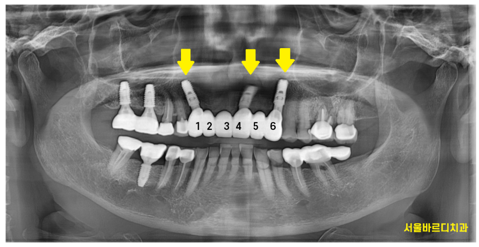 하남미사치과 앞니 브릿지를 임플란트로 교체했습니다. 관련 이미지 7