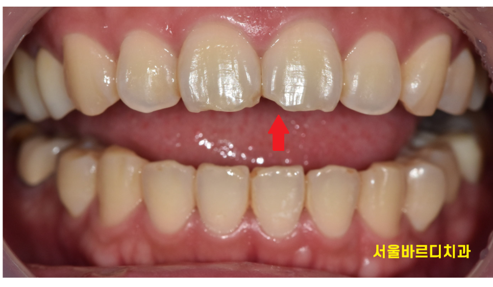 상일동역 라미네이트 치아 무삭제 정말 가능한가요? 관련 이미지 5