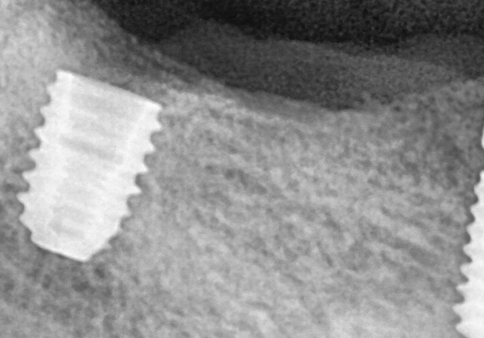 Sangil-dong Station Implant Visits: How Many Times Do You Actually Need to Go to the Dentist? image 7