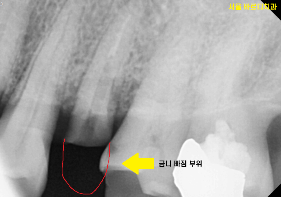 미사 임플란트 금니 빠짐 보철물 빠졌을 때 대처법 알려드려요 관련 이미지 4