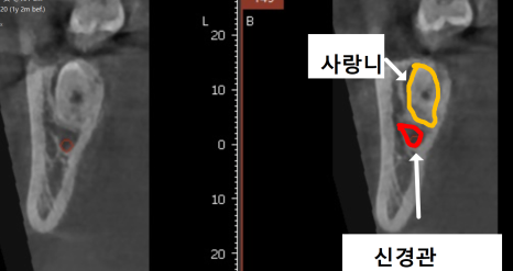 상일동 사랑니 매복 방치하다 옆 치아까지 망가진 실제 사례 관련 이미지 9