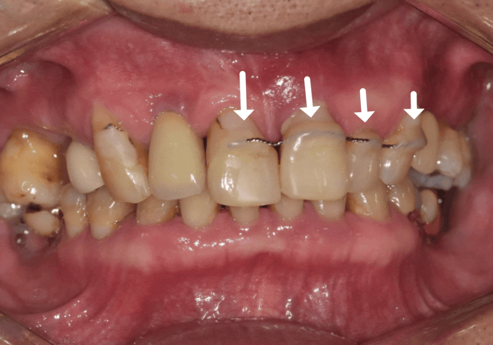 앞니 흔들림, 임플란트 치아보험 감액 기간 넘기려다 더 큰 손해 봅니다. 관련 이미지 5