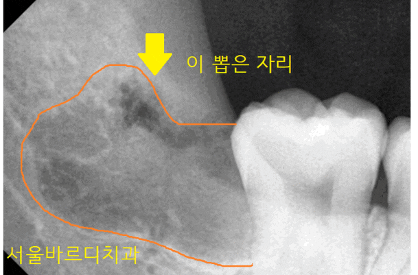 강동구 사랑니 묻혀있는 매복치아 꼼짝마!!! 뽑아줄테니까 관련 이미지 1