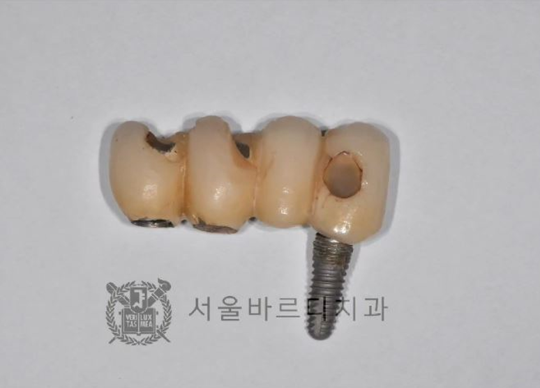 상일동역치과 서울바르디치과 무절개 네비게이션 임플란트 치료증례 #5 관련 이미지 8