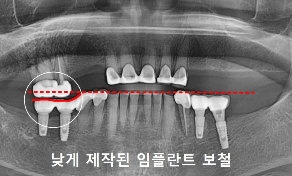 합죽이입 처럼 보이는 이유, 낮아진 관련 이미지 4