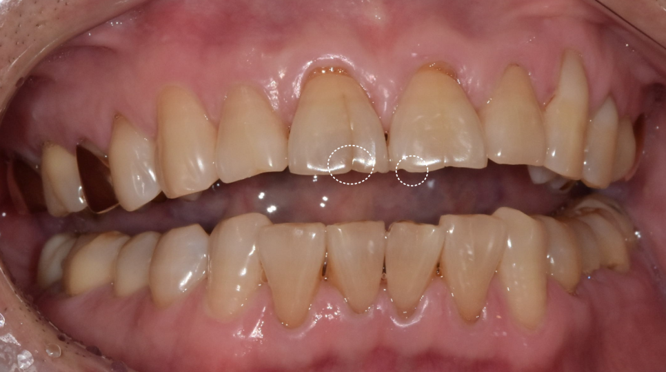 앞니 금 갔을 때, 방치하면 안 되는 진짜 이유 <파절 치료 사례> 관련 이미지 3