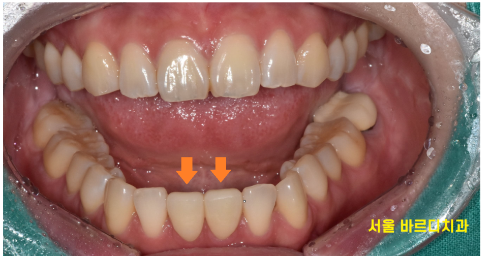 벌어진 아래 앞니 라미네이트로 감쪽같게 치료했습니다. 관련 이미지 8