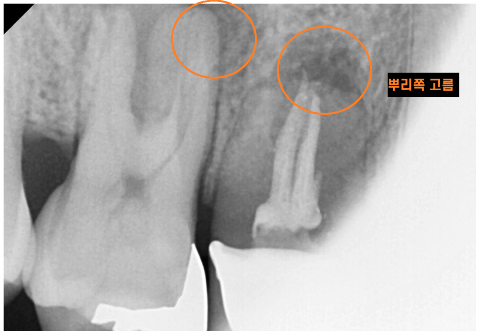 하남시청치과 신경치료 치아 발치 후 임플란트 했습니다. 관련 이미지 2