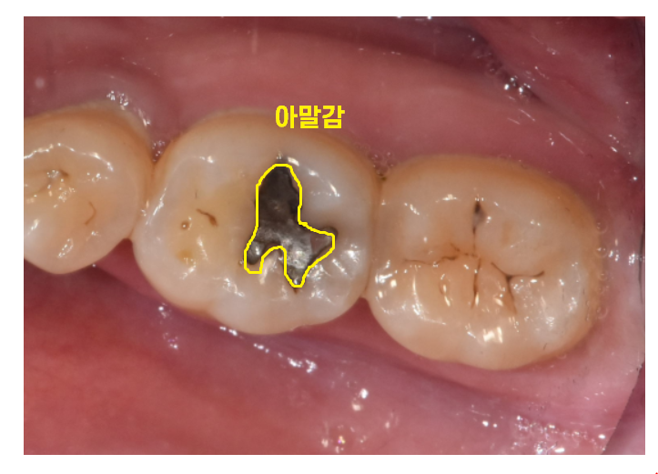 길동 치과 검은 점 충치 검정색이라고 다 치료할 필요는 읎다! 관련 이미지 5