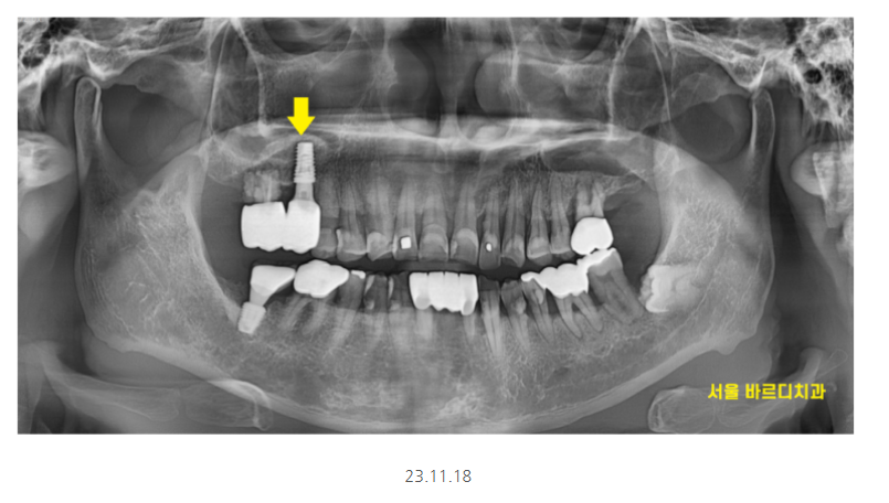 강일동 치과추천 어금니 시림 방치하다 발치하고 임플란트 하신 사연 관련 이미지 8