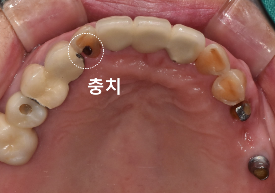 상일동 임플란트 심한 충치로 인한 치아 부러짐 해결한 사례 관련 이미지 2
