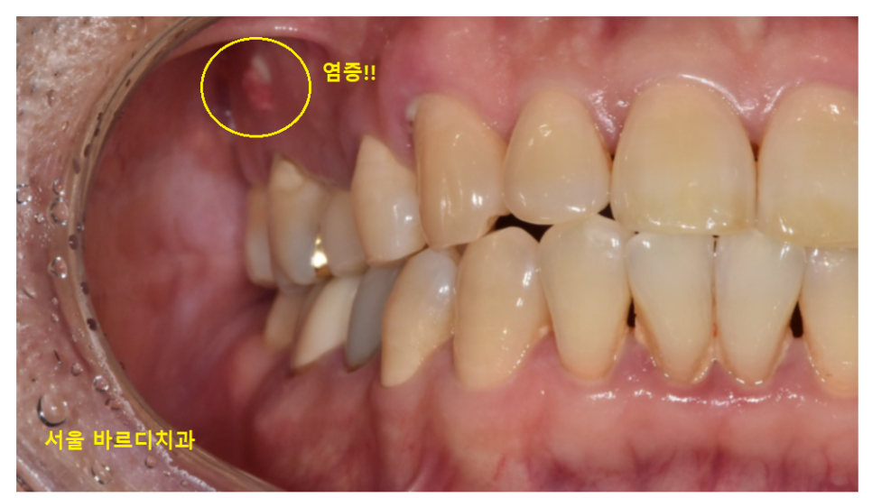 고덕역 임플란트 잇몸 뾰루지 뼈이식 두번 하여 해결했습니다. 관련 이미지 3