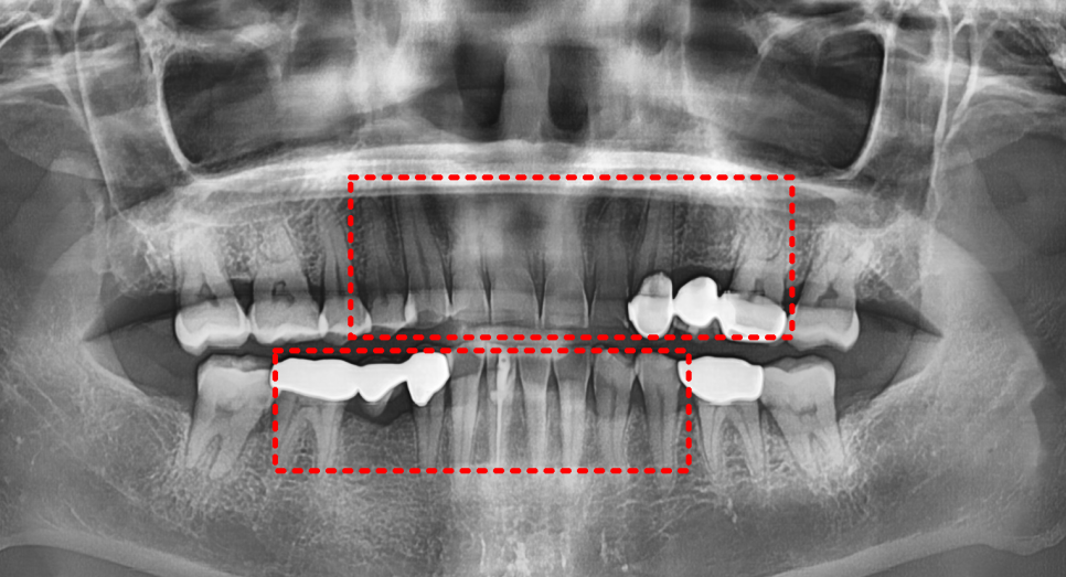 누런 치아 연예인치아 처럼 하얗게 만들 수 있나요? 관련 이미지 8