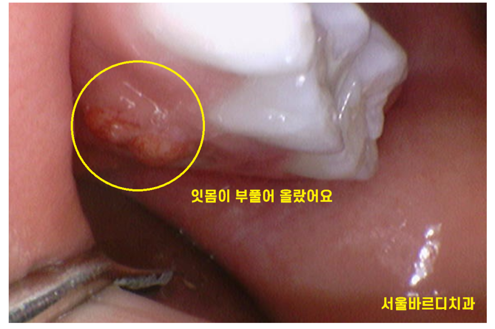 상일동 어린이치과 유치 곧 뽑을 치아이지만 치료가 필요한 이유 관련 이미지 2