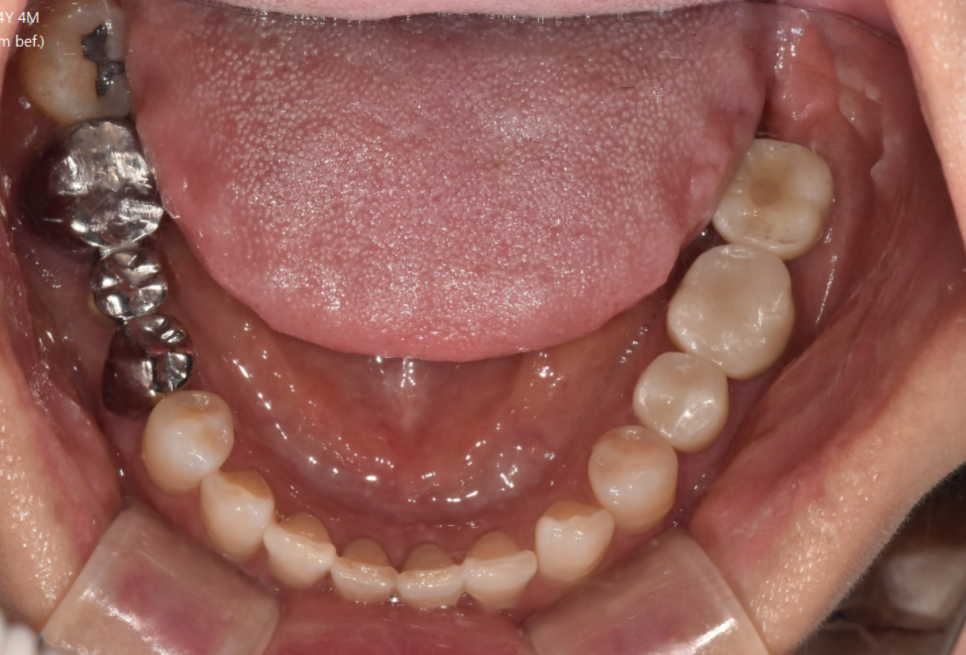 상일동역 치과 추천 임플란트 과정에서 제일 중요한 이것! 관련 이미지 5