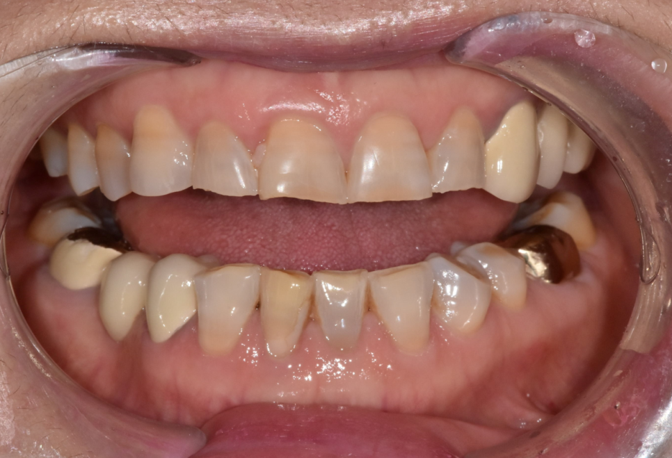 누런 치아 연예인치아 처럼 하얗게 만들 수 있나요? 관련 이미지 3