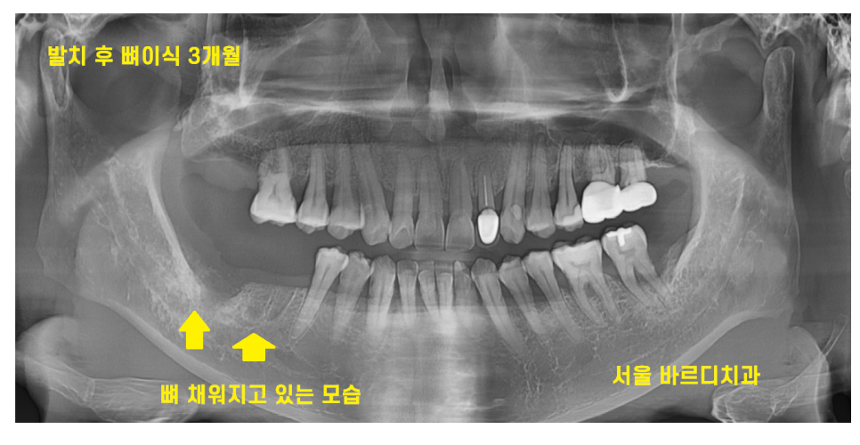 이 흔들림으로 발치 후 뼈이식 진행한 케이스 관련 이미지 8
