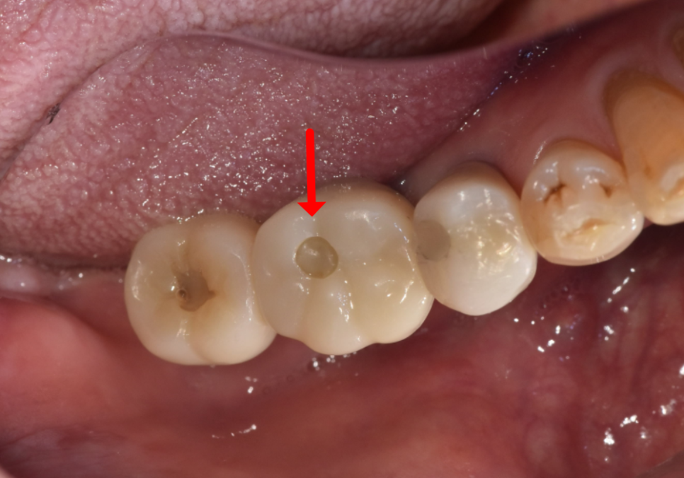 고덕 치과, 임플란트가 흔들려요. 뽑아야 할까 봐 고민이라면? 이렇게 해결합니다. 관련 이미지 12