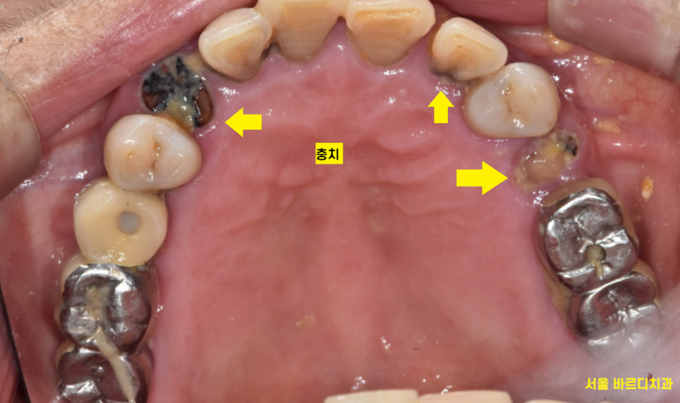 타치과 임플란트 as 수리 가능한 선동치과 관련 이미지 3