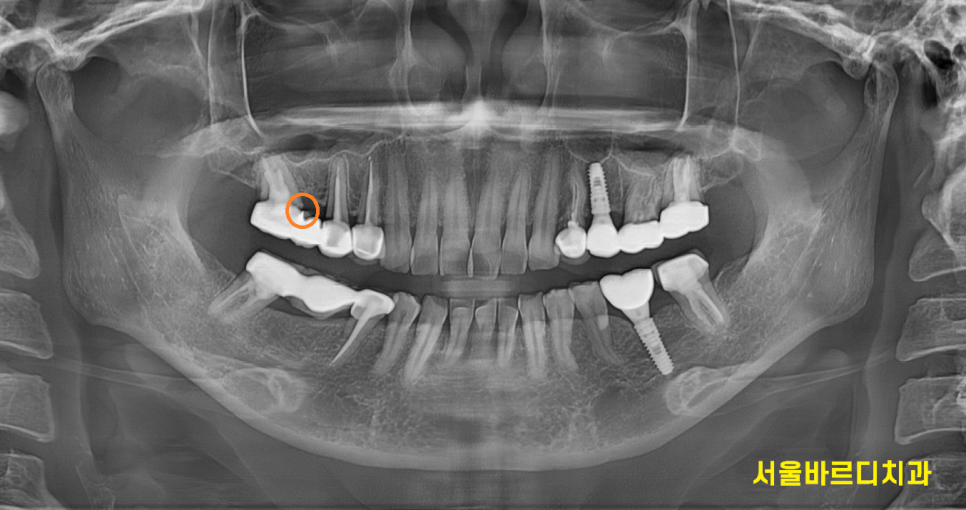 보철 부러짐 발생으로 치아 뿌리만 남았을 때 치료 방법 임플란트 관련 이미지 3