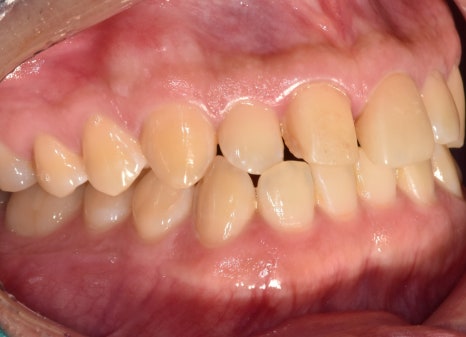 Gangdong-gu laminate failure and detachment: front teeth restored through retreatment image 4