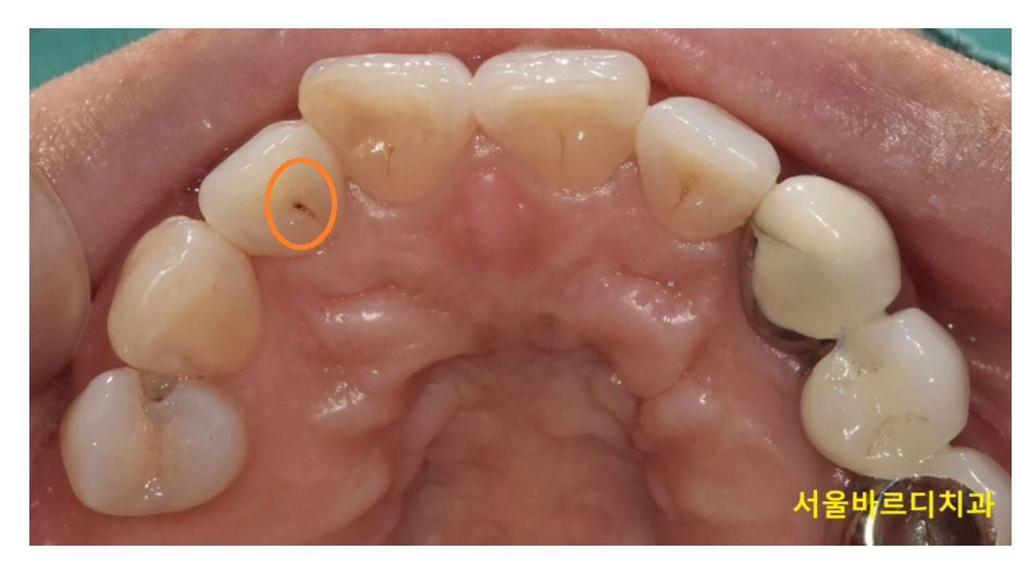충치치료 후 이시림 자연스러운 반응일까 후유증일까? 관련 이미지 6