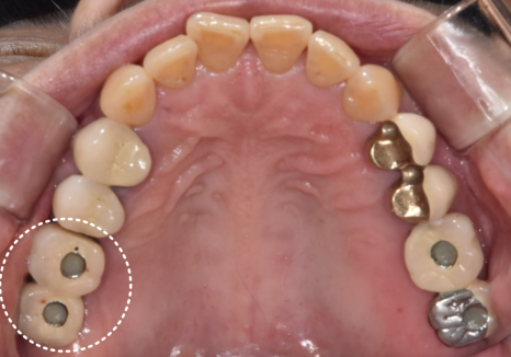 잇몸 고름 눌러보니 푹... 임플란트 주위염 방치했다가 재수술한 사례 관련 이미지 1