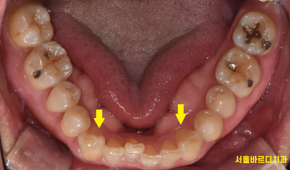 고덕역 근처 교정 치과 치료기간은 얼마나 걸릴까? 관련 이미지 4