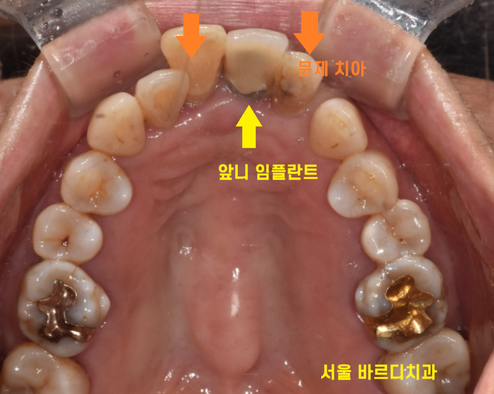 미사 임플란트 보철 새로하고 연결했습니다. 관련 이미지 4