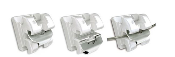 치아 교정기 종류 결정장애 환자분들을 위한 친절한 설명서 관련 이미지 6