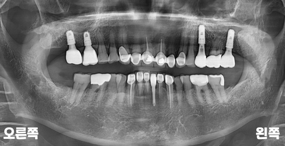서울바르디치과 뿌리 끝 염증 심한 치아를 네비게이션 임플란트 #6 관련 이미지 19