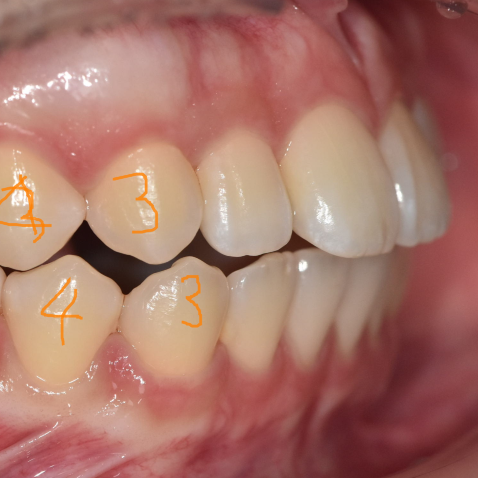 Can Protruding Mouth Be Corrected with Orthodontics Alone, Without Surgery? Sangil-dong Orthodontic Clinic image 8