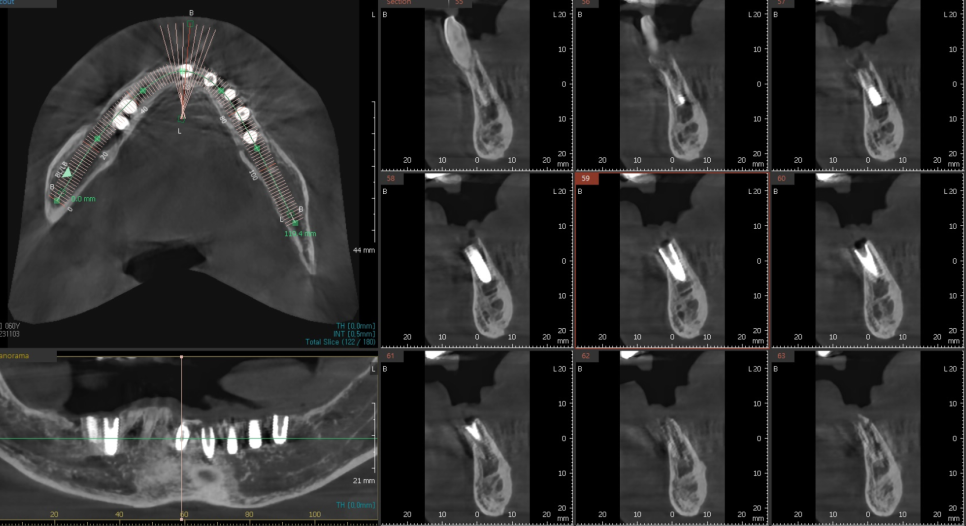 천호 디지털 가이드 임플란트, 일반 임플란트와 무슨 차이가 있나요? 관련 이미지 9