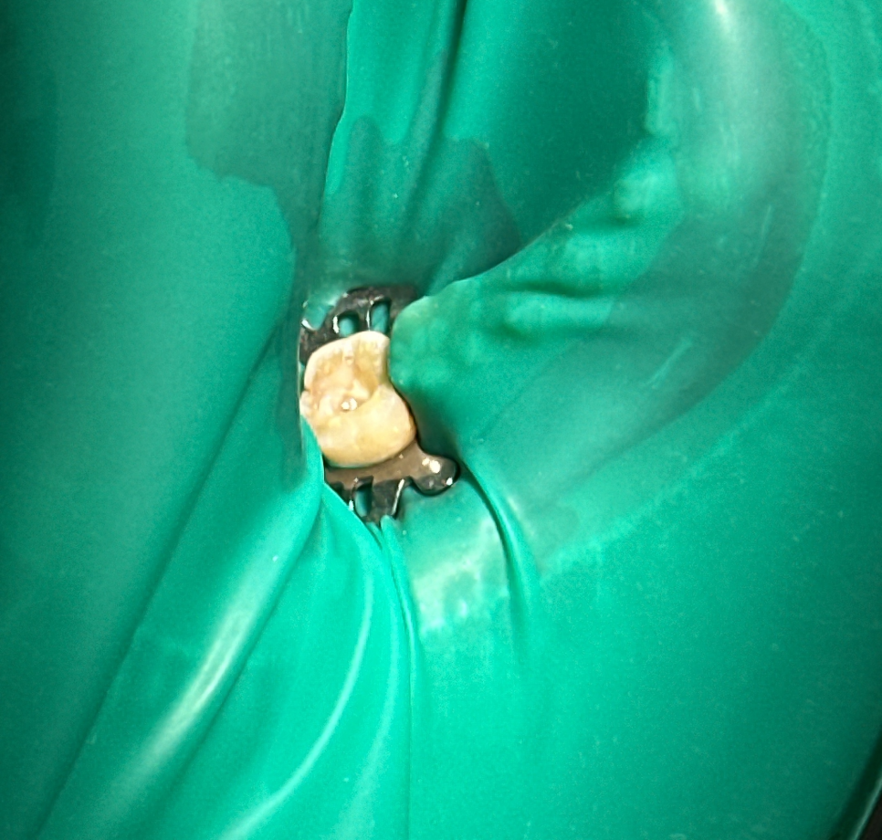 상일동 신경치료 러버댐이 무엇인지 궁금하신가요? 관련 이미지 3