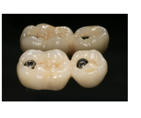 강동구 치과 임플란트 흔들림 나사 풀림 머리가 돌아가요!!! 대처법은? 관련 이미지 4