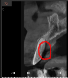 상일동역 치과 윗니 앞니 흔들림 임플란트로 심미까지 잡았습니다. 관련 이미지 4