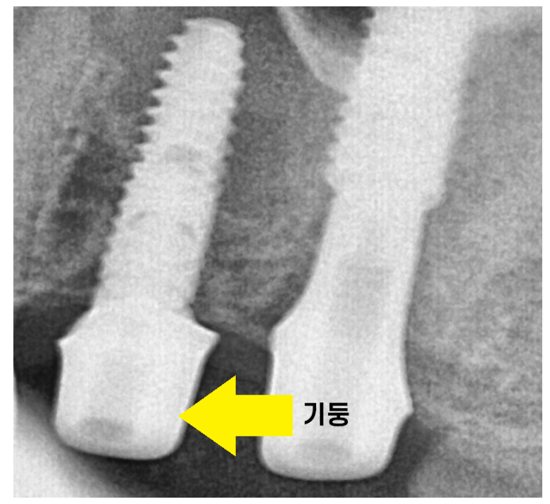 상일동 임플란트 수술 과정 시작부터 끝까지 따라와주세요! 관련 이미지 7