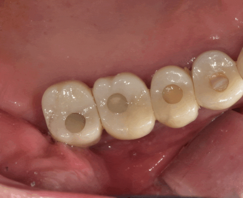 고덕동 치과치료 씌운 치아 문제가 생겼어요 관련 이미지 1