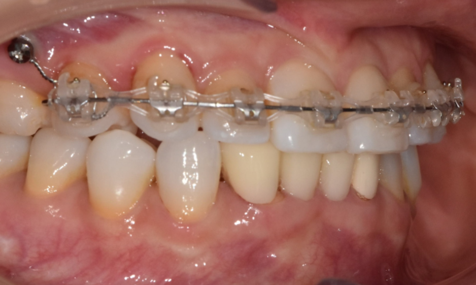 Solved My Concerns About Protruding Front Teeth with Partial Re-orthodontic Treatment of the Front Teeth image 7