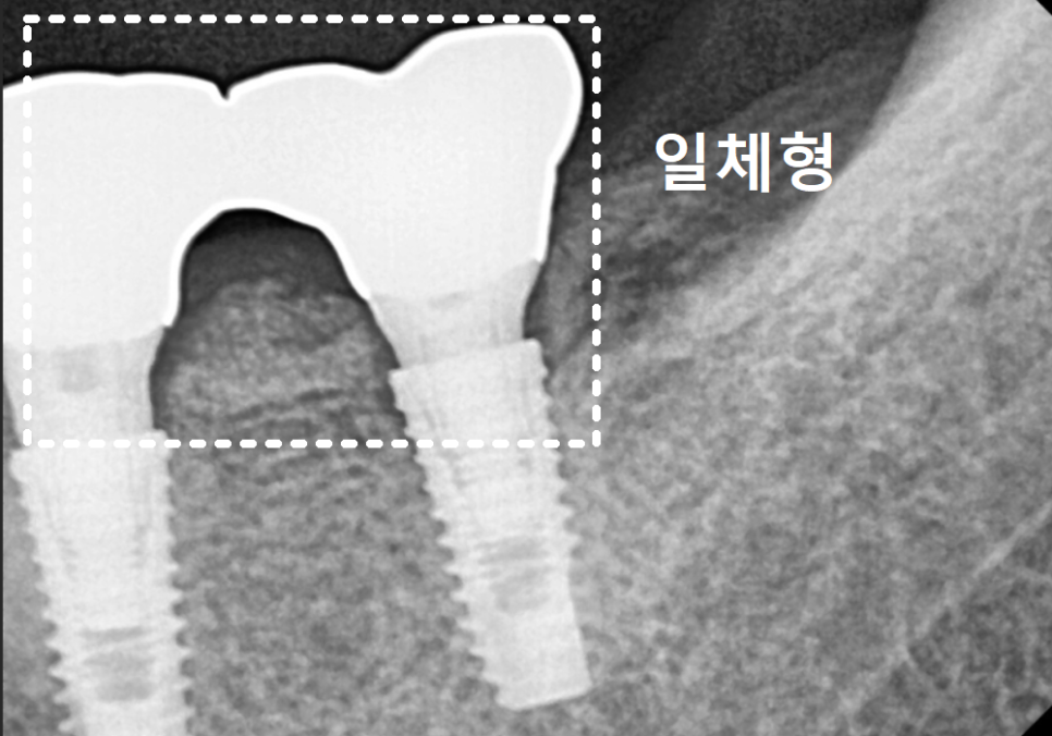 임플란트 움직임, 관련 이미지 12