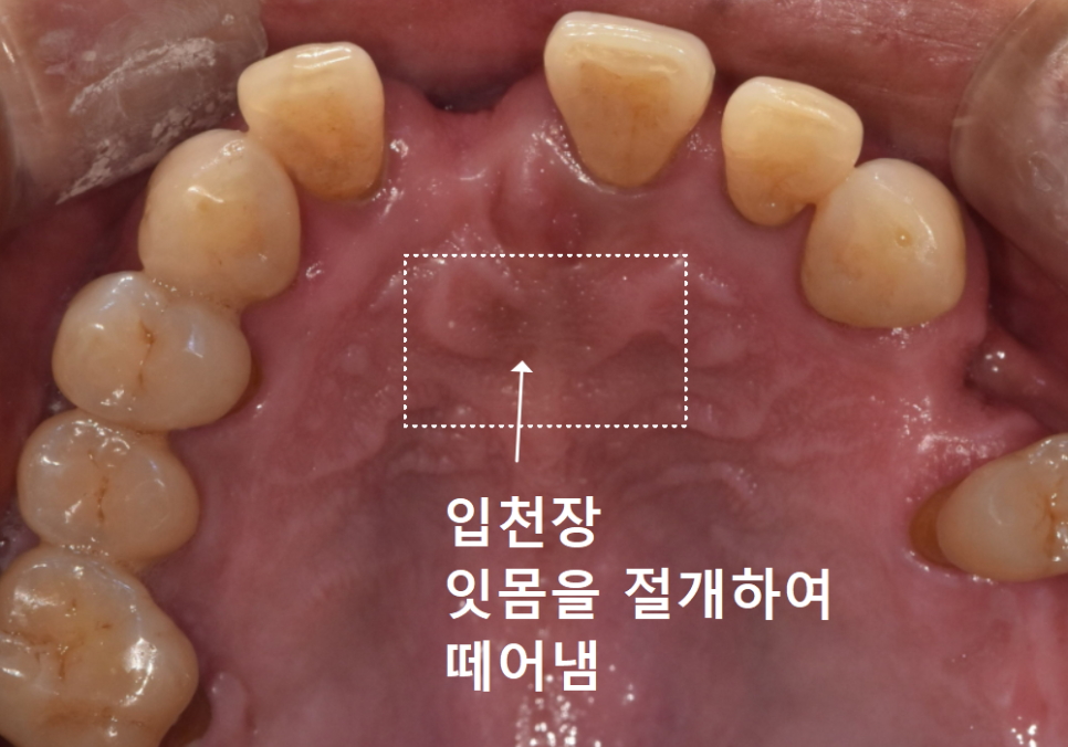 앞니 잇몸 꺼짐, 잇몸 이식 없이도 임플란트 할 수 있는 방법 공개합니다. 관련 이미지 11